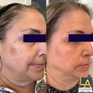 Laser Resurfacing